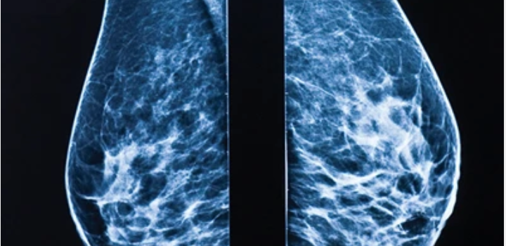 UCSF Breast Imaging