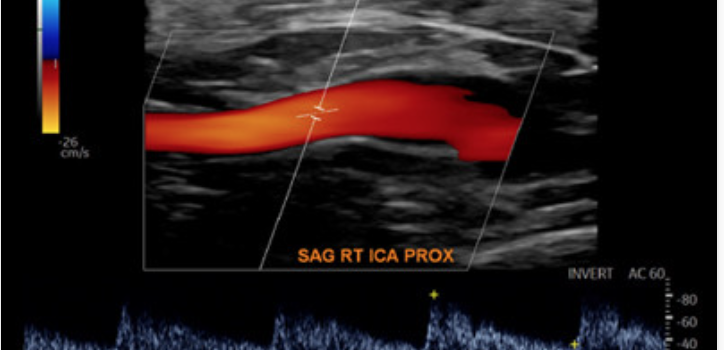 Society for Vascular Medicine Comprehensive Review of Vascular Ultrasound Interpretation and Registry Preparation Society for Vascular Medicine Comprehensive Review of Vascular Ultrasound Interpretation and Registry Preparation