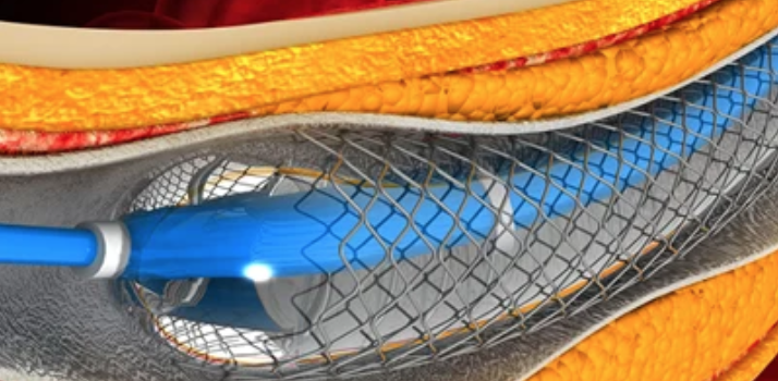 Comprehensive Review and Update of What’s New in Vascular and Endovascular Surgery