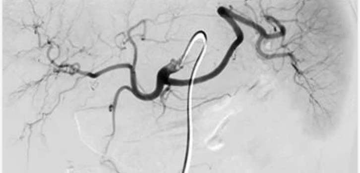 NYU Langone Vascular and Interventional Radiology Review and Update