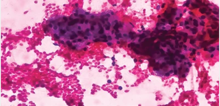 Advances in Cytology and Small Biopsies